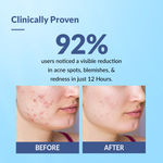 Buy Fixderma Salyzap Acne Spot Corrector Gel with Salicylic Acid & Aczero Reduce Acne Pimples 20 gm - Purplle