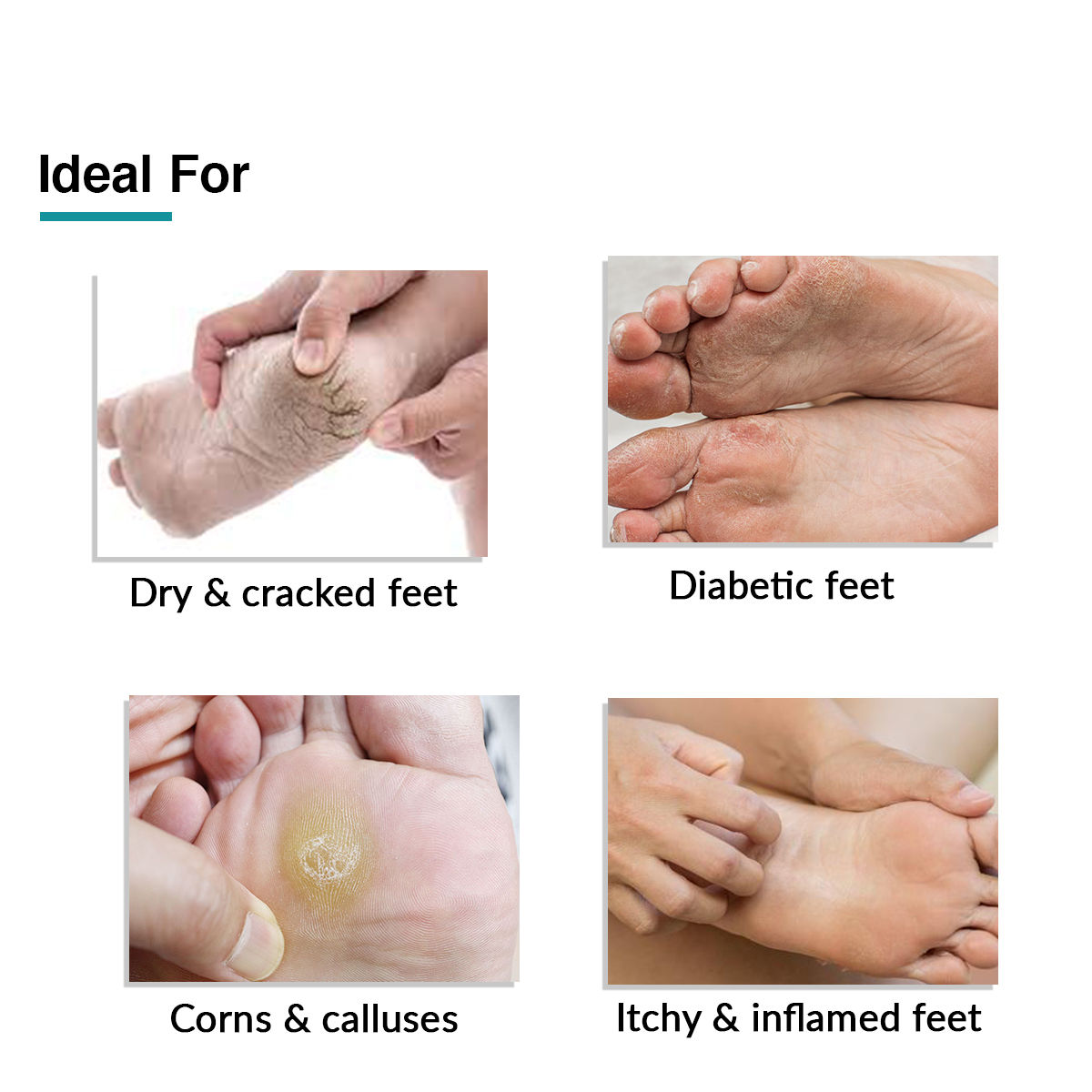 Dry Feet Diabetic Foot Cream For Cracked Heels Diabetes Dry