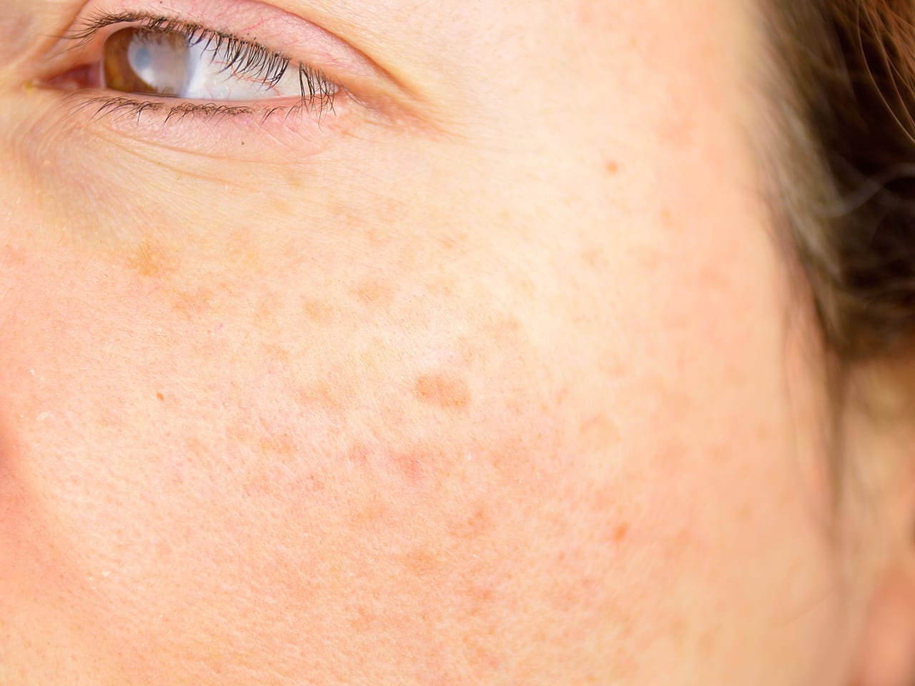 Photoageing Causes of ageing