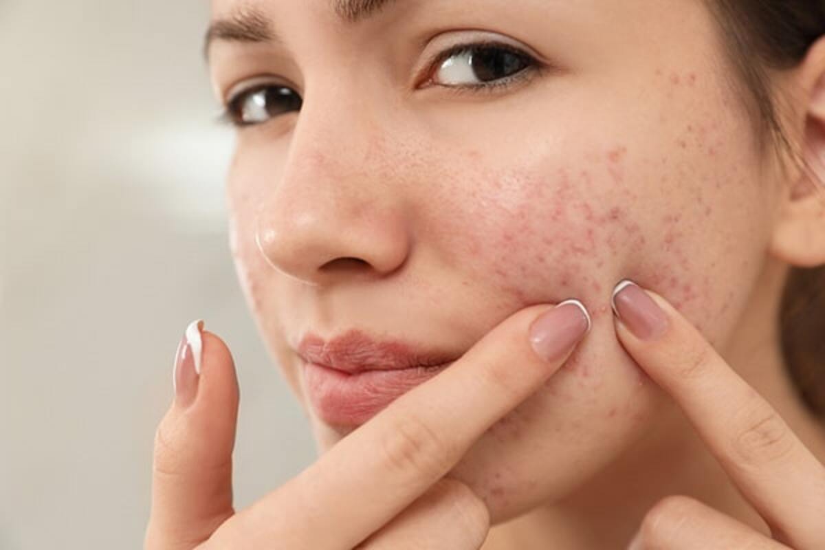 Foods To Avoid For Acne: What To Eat As To Achieve Clear, Healthy & Glowing  Skin