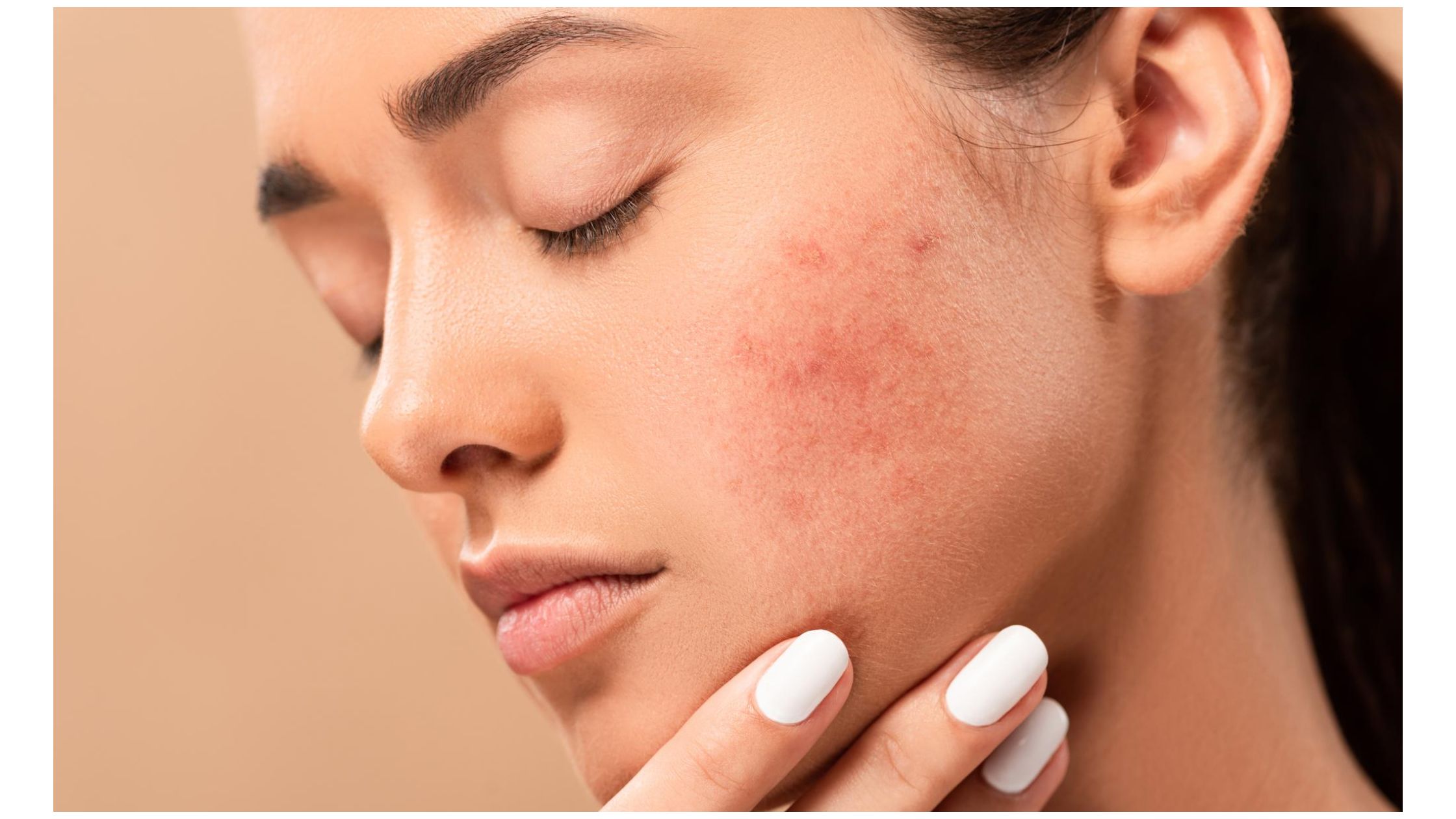 how to remove dark spots on face caused by pimples naturally