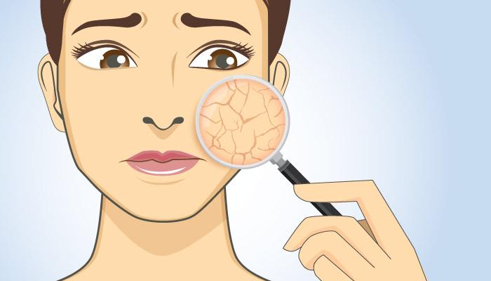 Causes of ageing - Dry skin