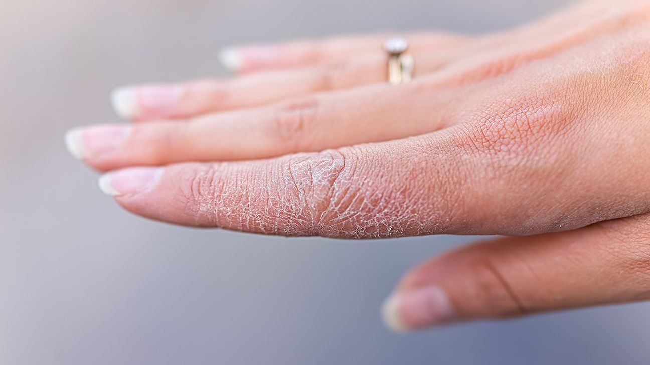 hand cream Heals Dry, Cracked Skin