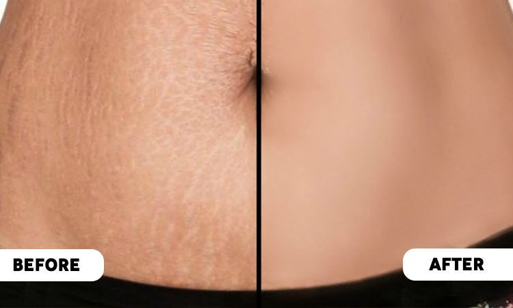 shea butter fades the appearance of stretch marks