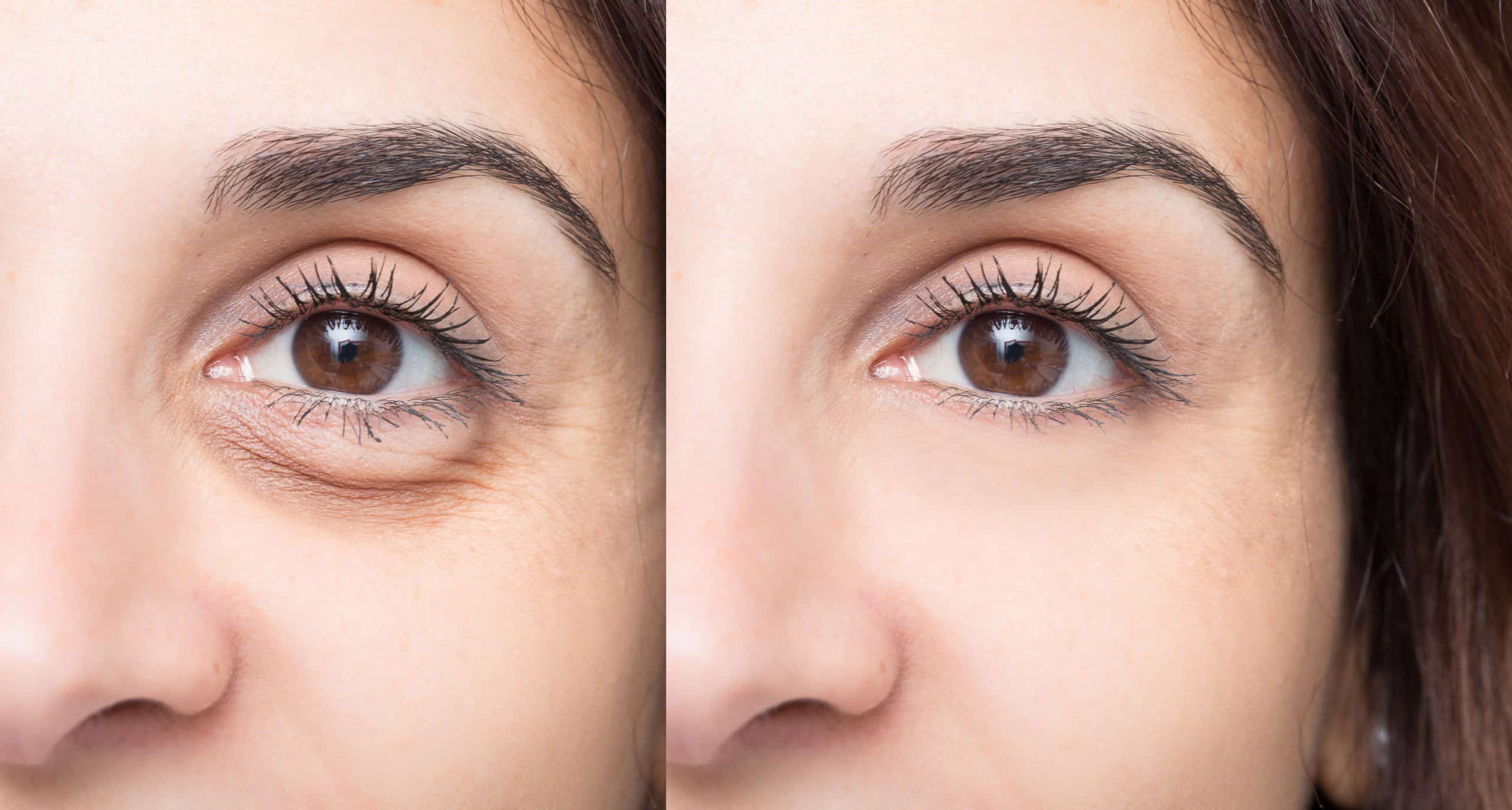 How to get rid of puffy eyes - LOOKFANTASTIC