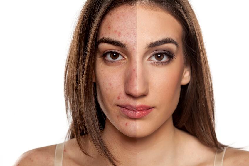Prevents scars and blemishes