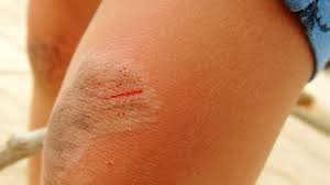  Vaseline Helps Heal Burns and Minor Skin Scrapes