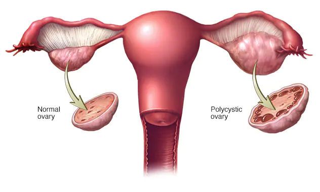 Reason for missed period - Polycystic ovary syndrome (PCOS)