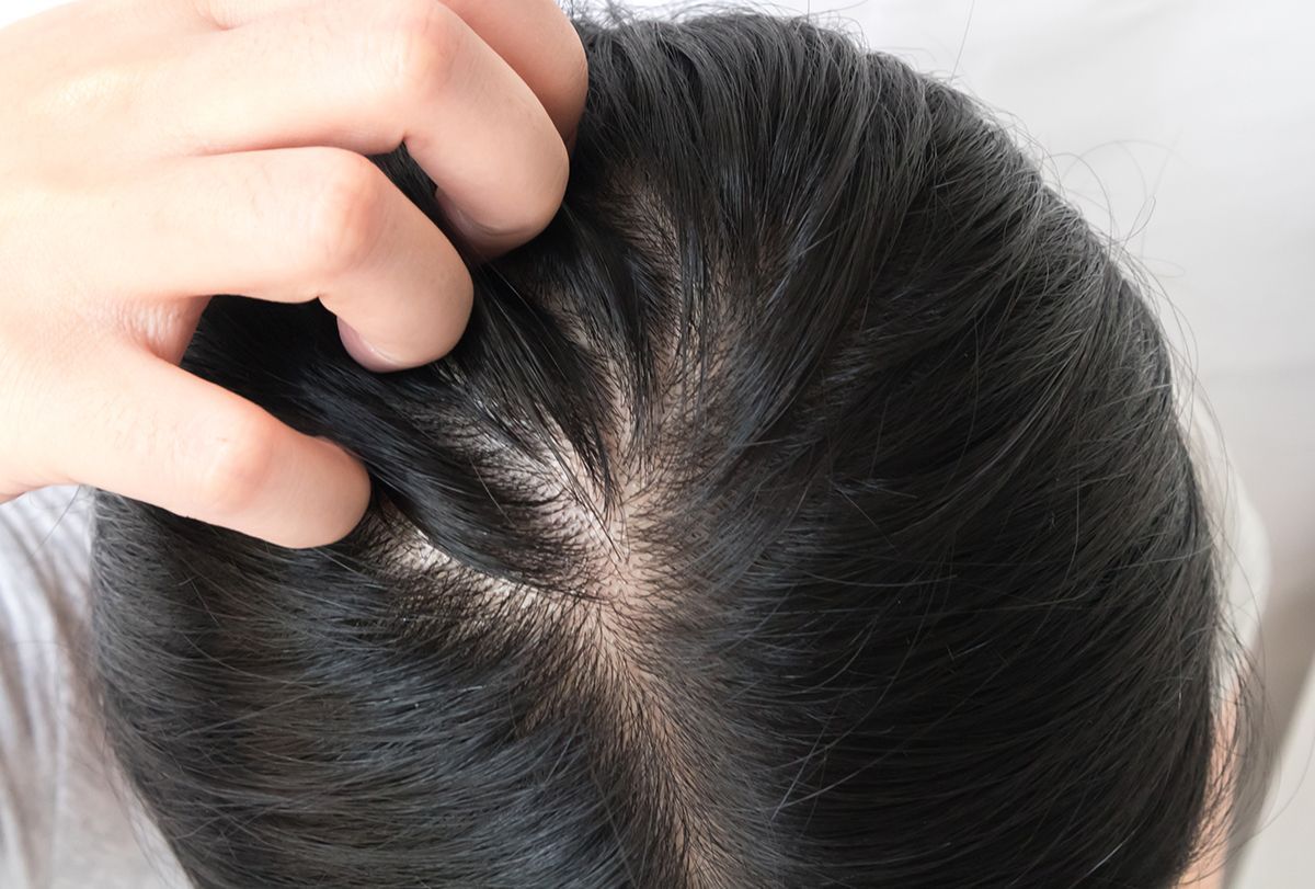 Incredible Home Remedies for Itchy Scalp in monsoon season