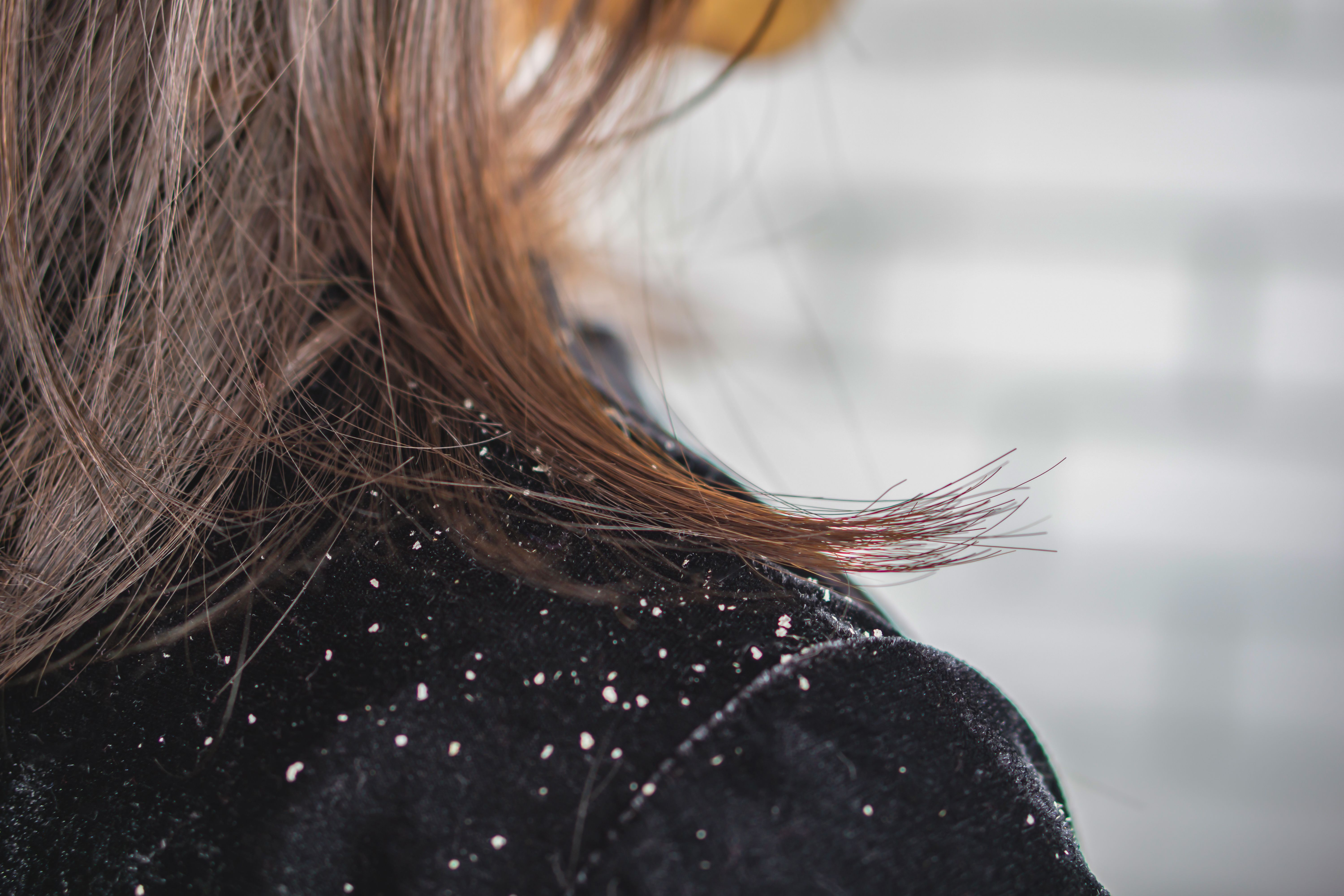 How to Cure Dandruff Permanently? Home remedies for dandruff