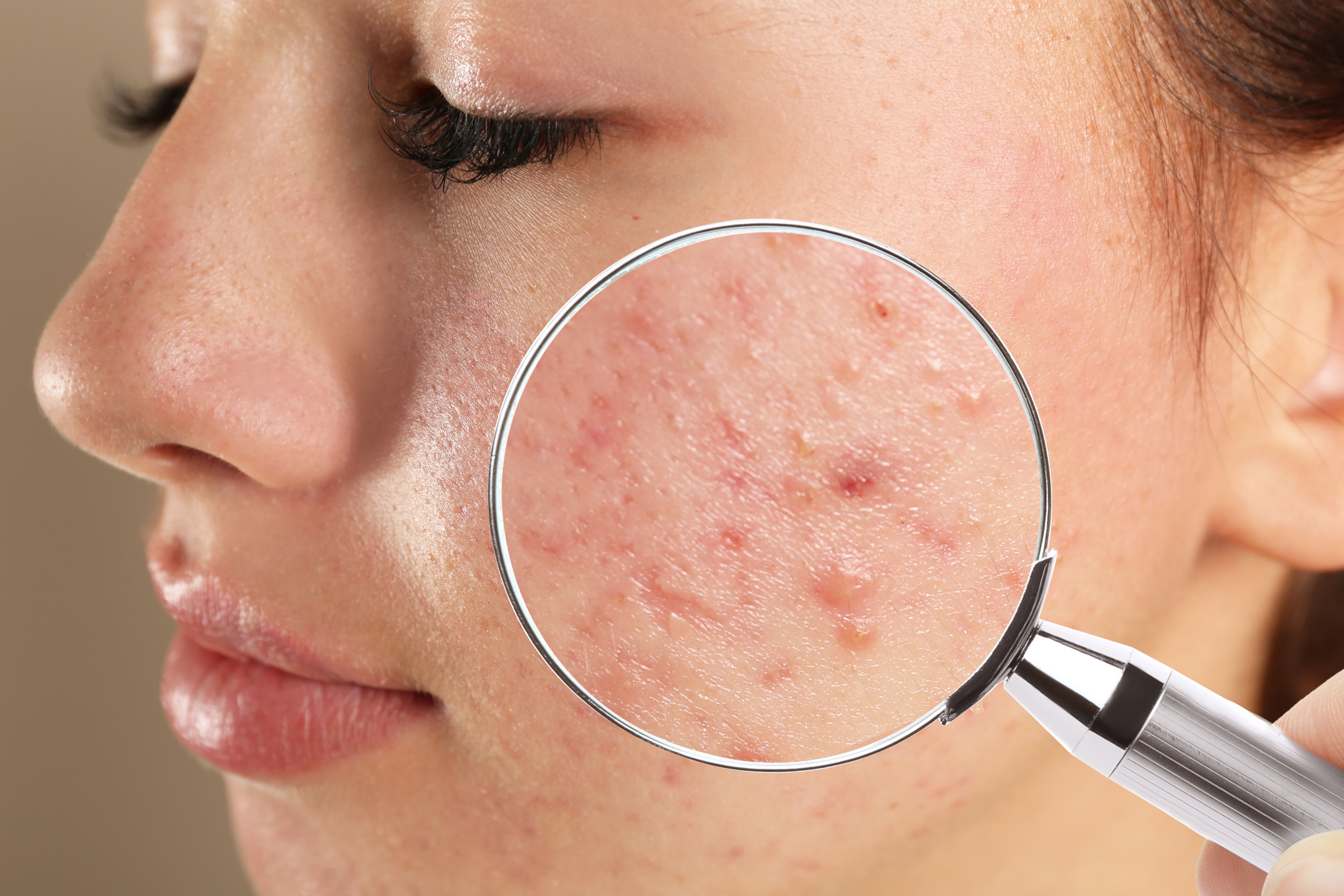 How Can You Use Glycerin To Cure Acne - Purplle
