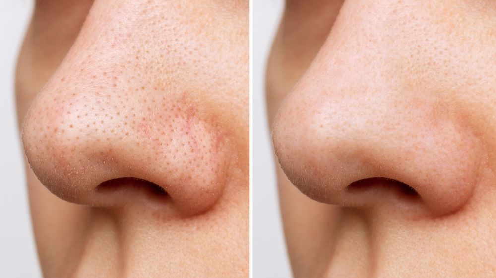 What are Blackheads? Symptoms, Causes & Treatment