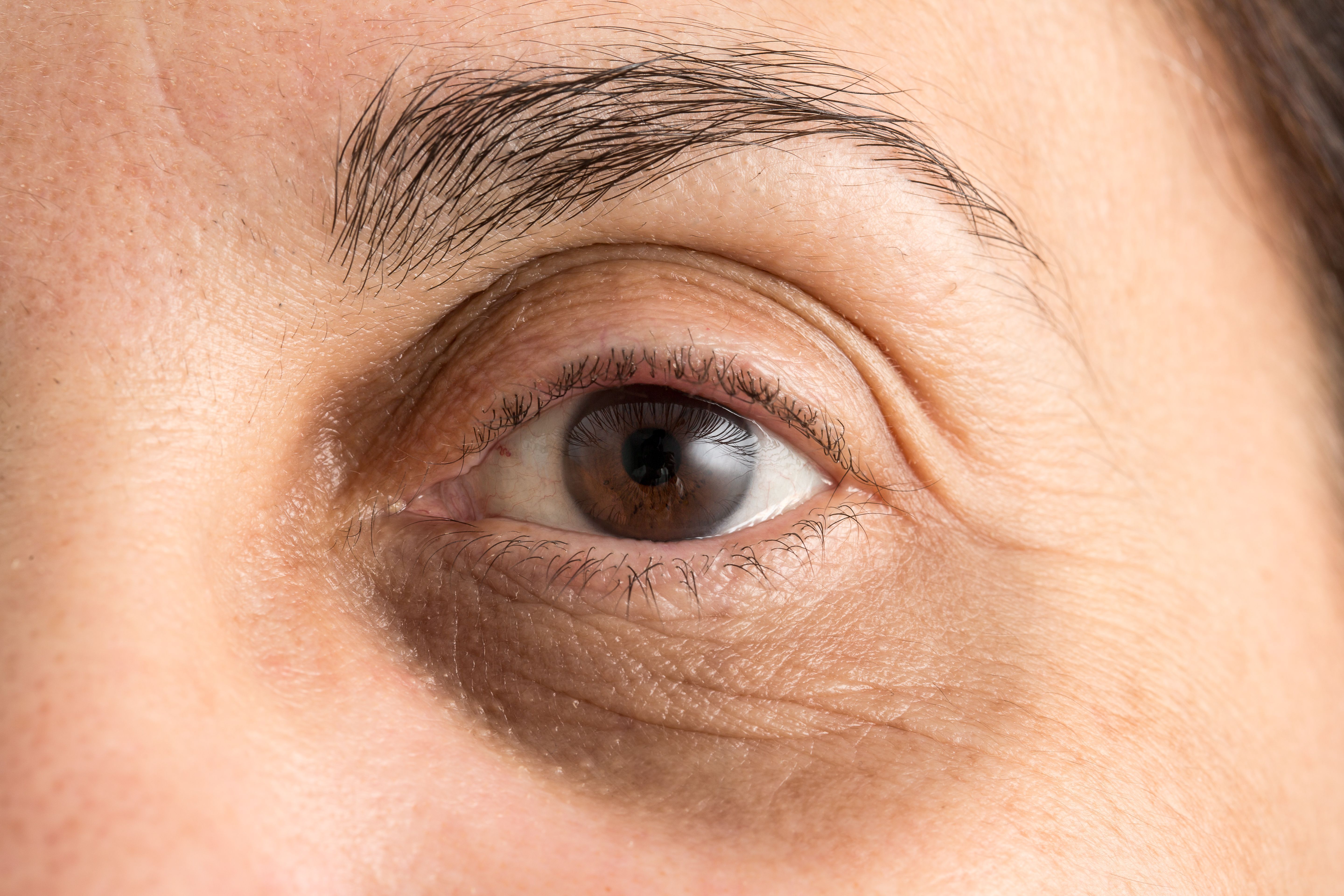 How to Treat Under Eye Bags and Wrinkles  DiscoverHealth