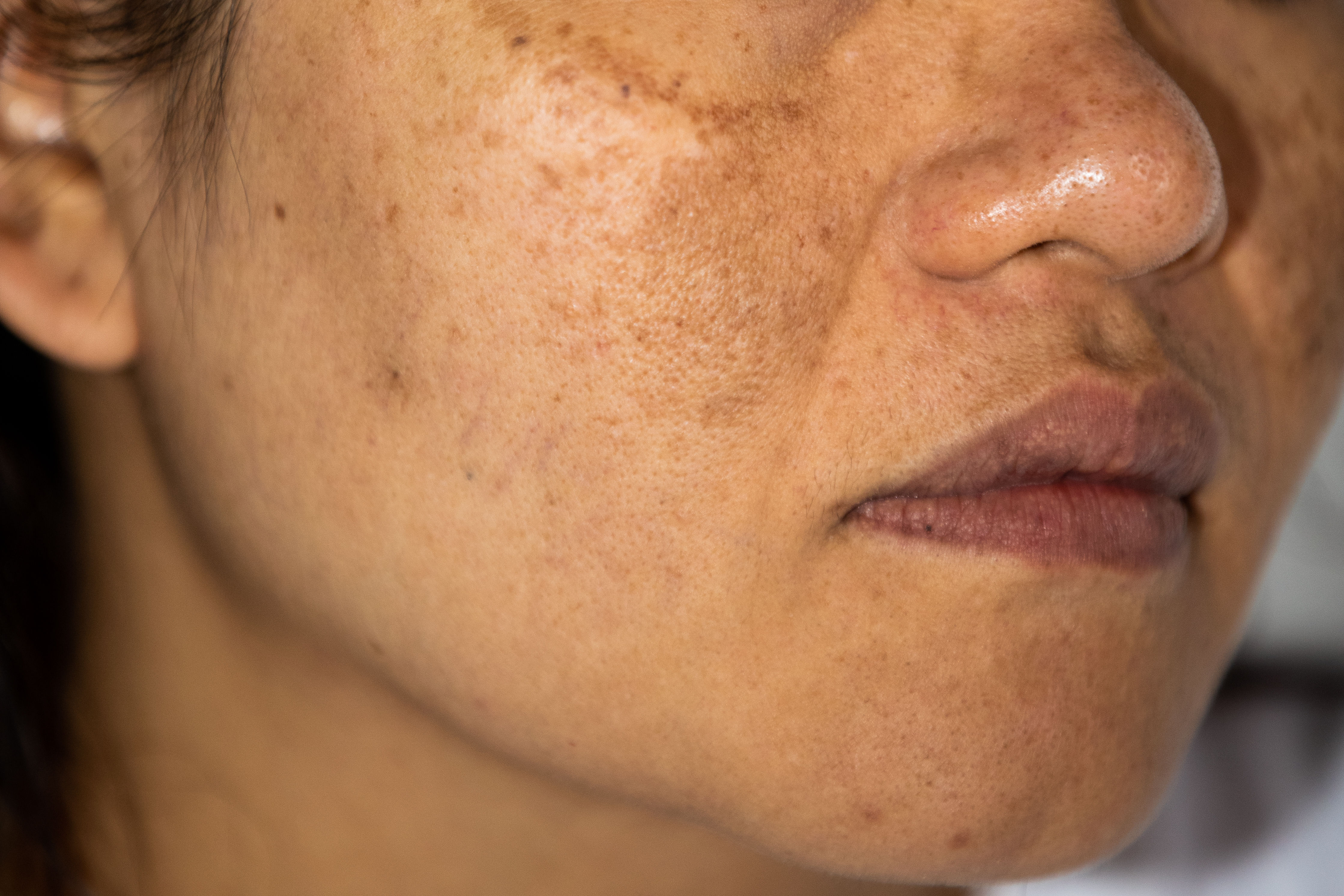 Home Remedies For Hyperpigmentation