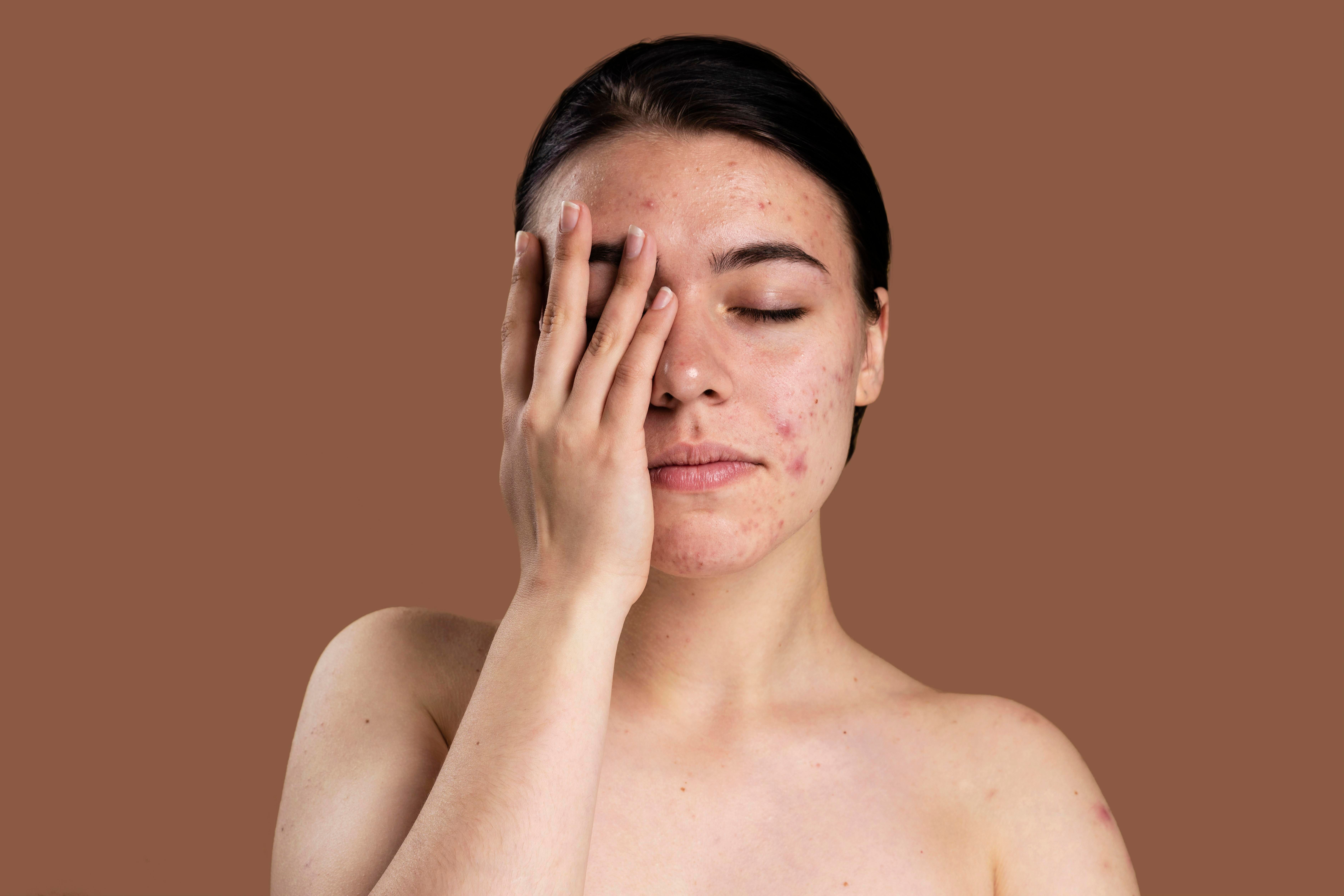 Benefits of vitamin E: Reduces Acne Scars