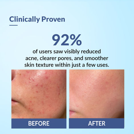 Fixderma Acne Face Pack with Aloe Vera Gel | Neem Face Pack | Aloevera Gel  for Skin | | Anti Acne Cream | Face Pack for Women | Treatment for Acne  Prone Skin - 50gm