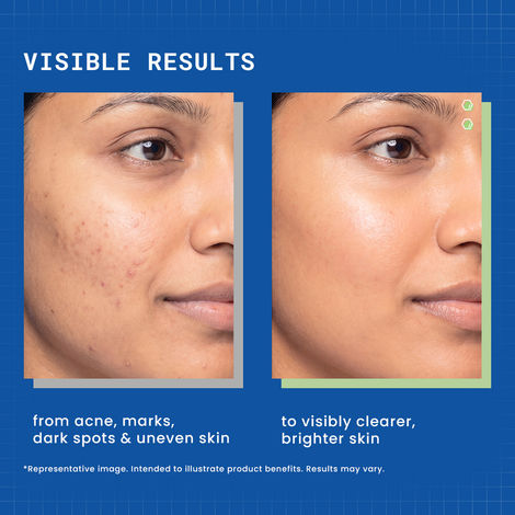 DERMDOC by Purplle 4% Niacinamide Face Cream (50 gm)