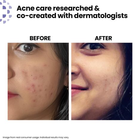 Buy Kaya Acne Care Purifying Cleanser Salicylic Acid Face Wash Reduces Acne & Pimples for Pimple Prone Skin Face Wash for Oily Skin, (100 ml)-Purplle